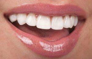 Durability of Porcelain Veneers