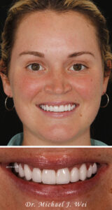 Morgan M smile makeover Dr. Michael J. Wei